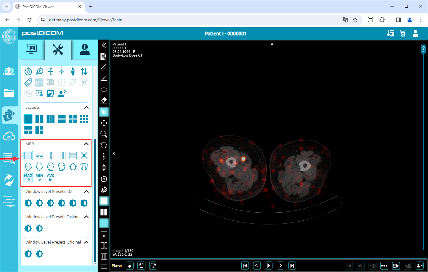 PET/CT, PET/MR Fusion