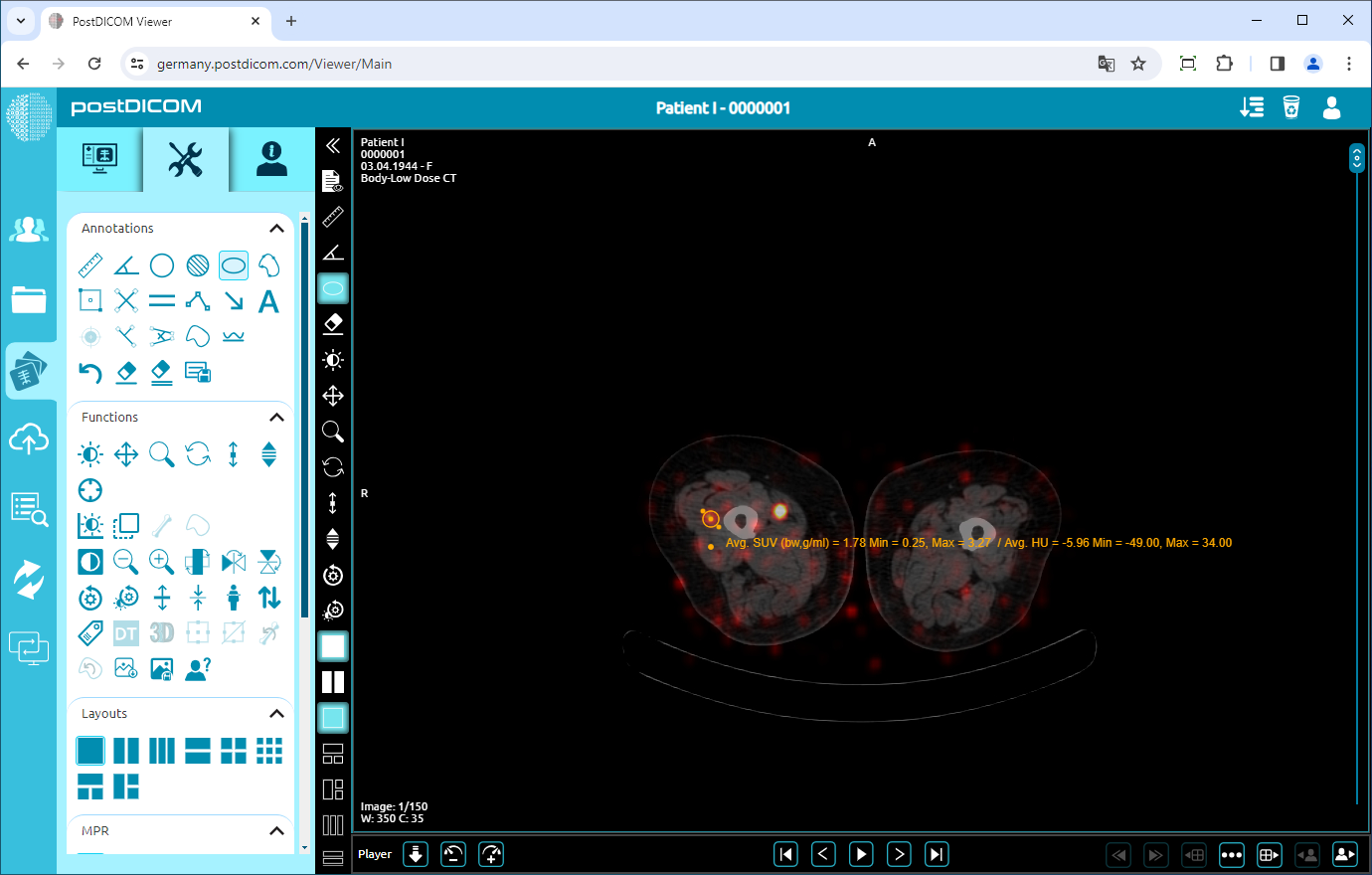 PET/CT, PET/MR Fusion